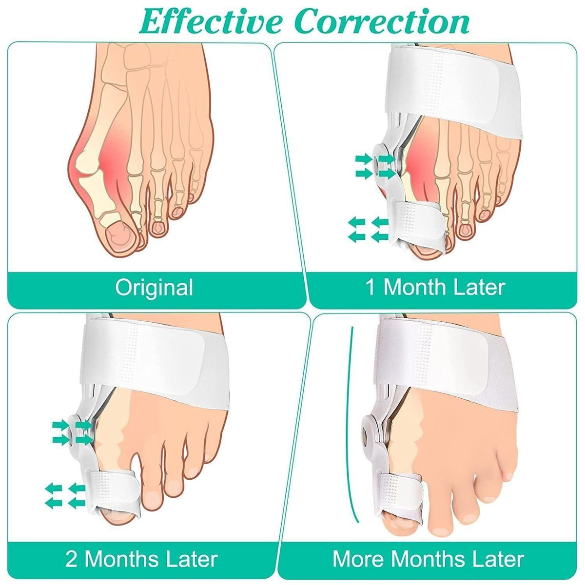 Silicon Toe Separator For Adults Bunion Corrector Splint Kit For Toe