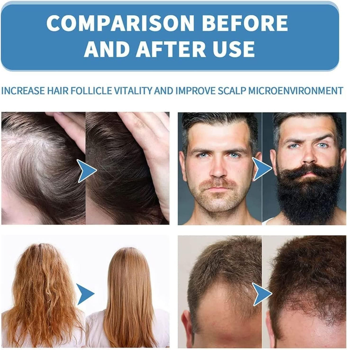 Minoxi Roll-On Hair Treatment Hair Growth Serum For Women & Men