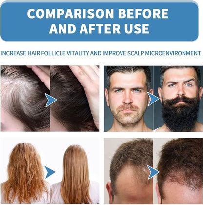 Minoxi Roll-On Hair Treatment Hair Growth Serum For Women & Men
