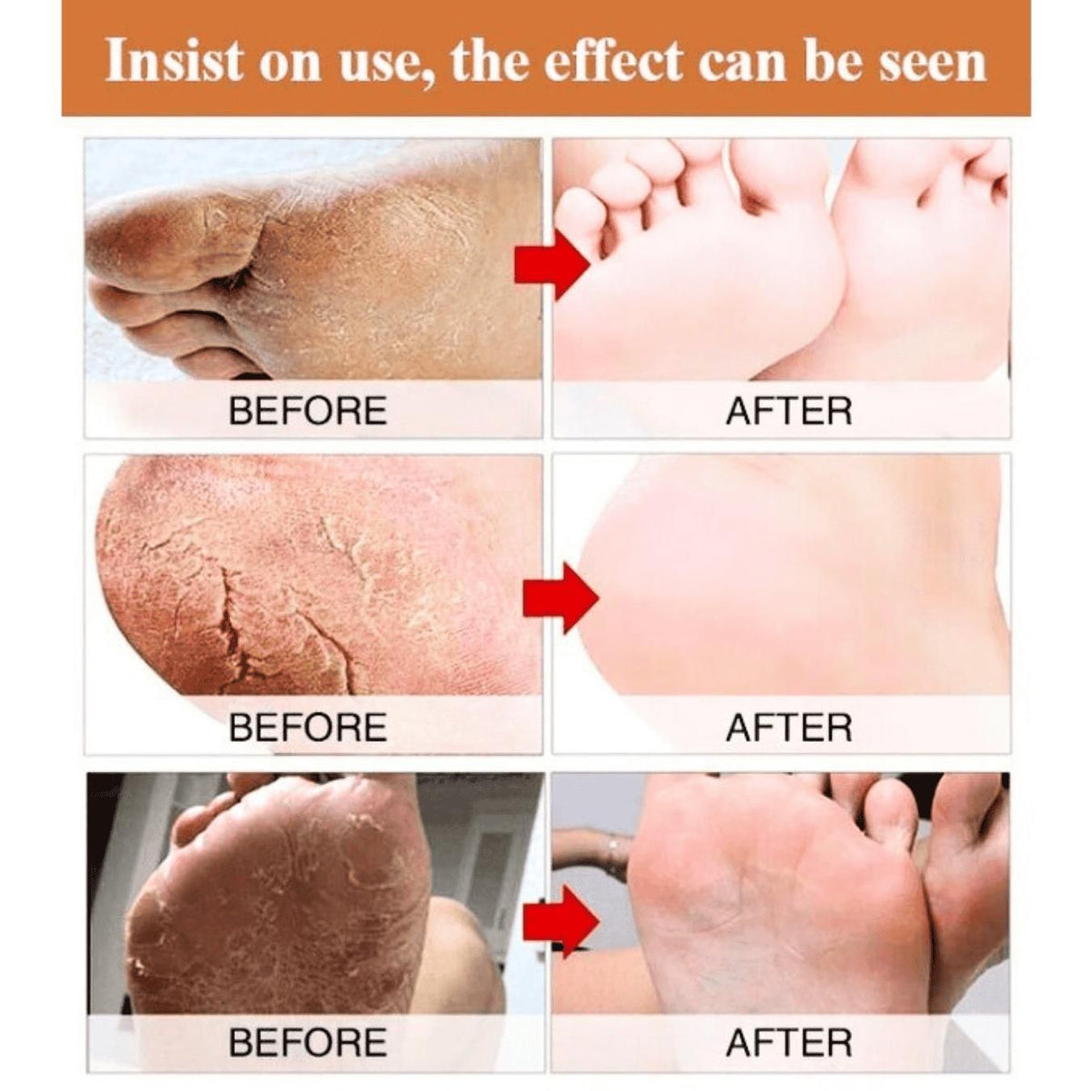 Foot Cream for Cracked and Dry Skin, Heel, Finger Healing Balm and Blaster