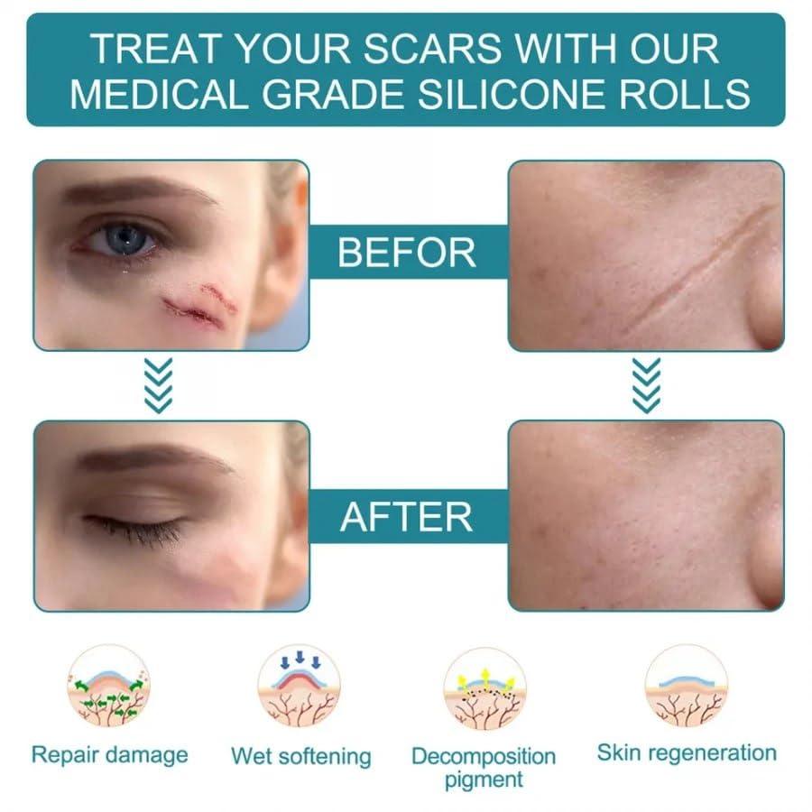 Silicon Scar Sheets, Silicon gel sheets for Scars Transparent Medical Silicon Gel Tape