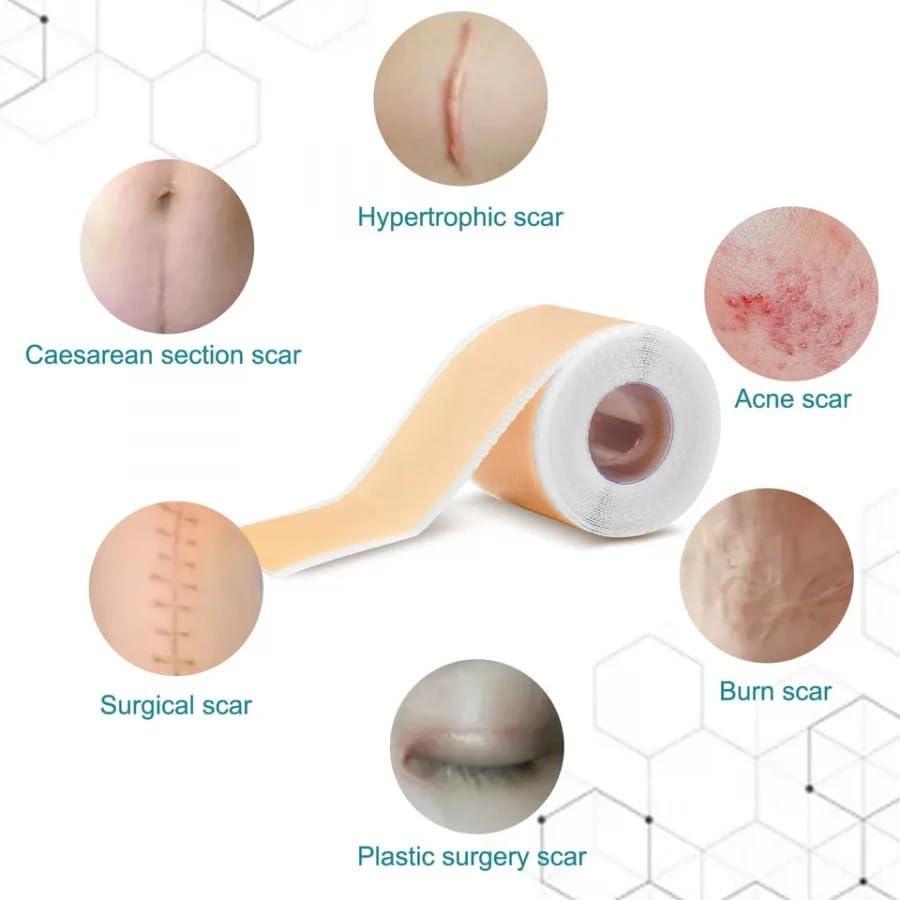 Silicon Scar Sheets, Silicon gel sheets for Scars Transparent Medical Silicon Gel Tape