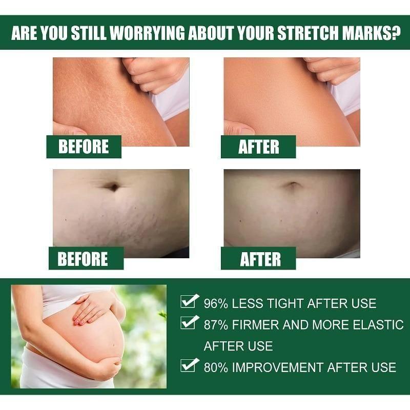 Bejoy  Pregnancy Scars, Acne Remove Cream