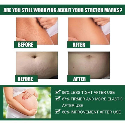 Bejoy  Pregnancy Scars, Acne Remove Cream